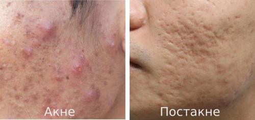 Как убрать следы от прыщей на попе. Герпес на ягодицах 03 Как убрать следы от прыщей на попе. Герпес на ягодицах 03