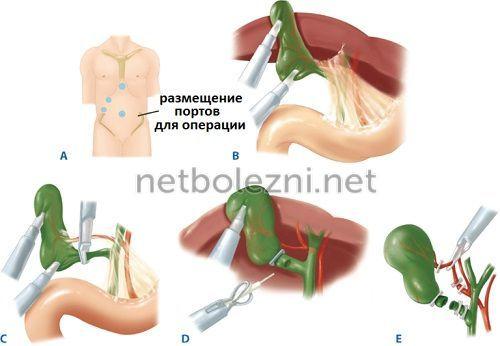 Что можно кушать после удаления желчного пузыря. Как работает организм после холецистэктомии? 01 Что можно кушать после удаления желчного пузыря. Как работает организм после холецистэктомии? 01
