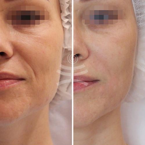 Что такое инъекционные техники удаления морщин. Инъекционные техники