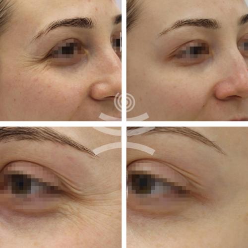 Что такое инъекционные техники удаления морщин. Инъекционные техники