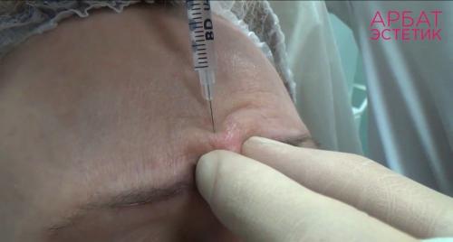 Подробно о инъекционных техниках удаления морщин 12 Подробно о инъекционных техниках удаления морщин 12