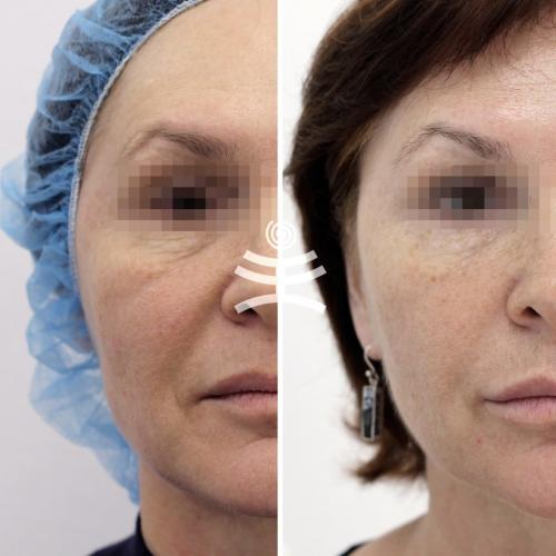 Что такое инъекционные техники удаления морщин. Инъекционные техники