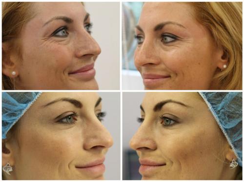 Что такое инъекционные техники удаления морщин. Инъекционные техники