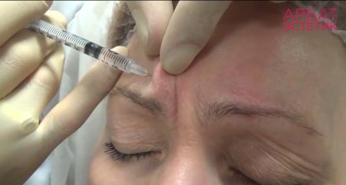 Подробно о инъекционных техниках удаления морщин 11 Подробно о инъекционных техниках удаления морщин 11