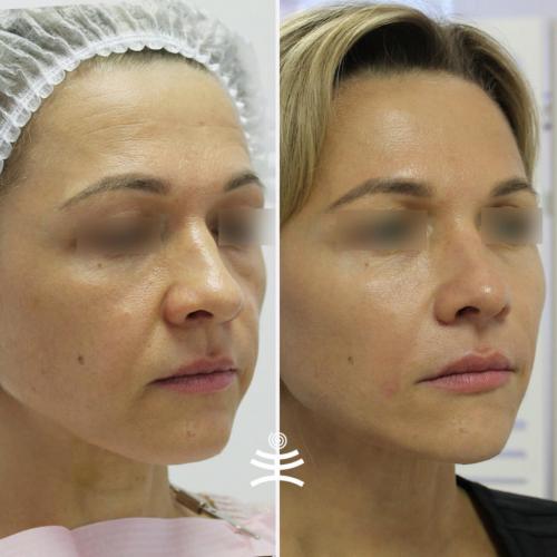 Что такое инъекционные техники удаления морщин. Инъекционные техники