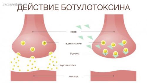 Победите морщины вокруг глаз с помощью мезоботокса 01 Победите морщины вокруг глаз с помощью мезоботокса 01