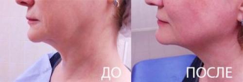 Как убрать брыли после 50 лет. Как работает нитевой лифтинг?