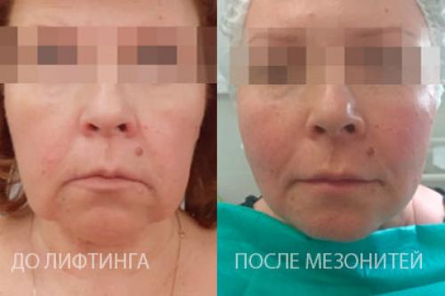 Как убрать брыли после 50 лет. Как работает нитевой лифтинг?