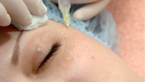 ТОП лучших процедур вокруг глаз. Почему появляются синяки и круги под глазами? 02