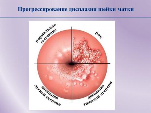 Шейка матки снаружи выстлана многослойным плоским эпителием.. II. Истинная эрозия шейки матки 03 Шейка матки снаружи выстлана многослойным плоским эпителием.. II. Истинная эрозия шейки матки 03