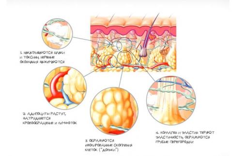 Как избавиться от целлюлита при варикозе.  Нарушение микроциркуляции крови и лимфы