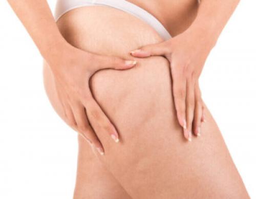 Упражнения от целлюлита при варикозе. Как избавиться от целлюлита на бедрах и ягодицах