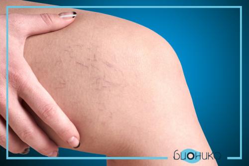 Как избавиться от целлюлита при варикозе.  Нарушение микроциркуляции крови и лимфы 02