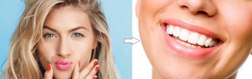 Можно ли устранить кисетные морщины над верхней губой с помощью домашних средств. Борьба с морщинами в домашних условиях и народными средствами