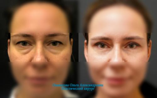 Морщины на скулах под глазами. Упражнения для устранения мешков под глазами