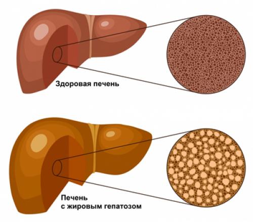 Запрещенные продукты при гепатозе печени. Общие правила