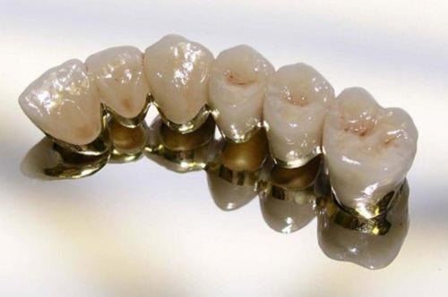 Что можно есть металлокерамическими зубами. 5 фактов о металлокерамике, которые вы не знали