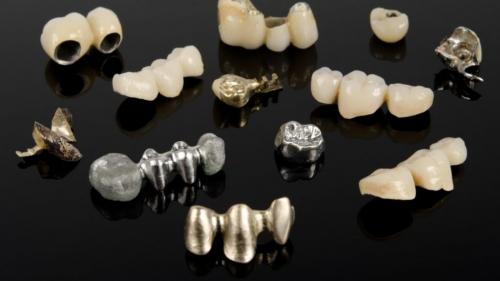 Что можно есть металлокерамическими зубами. 5 фактов о металлокерамике, которые вы не знали