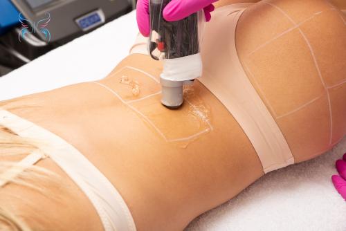 Александритовый лазер после процедуры. Как проходит процедура