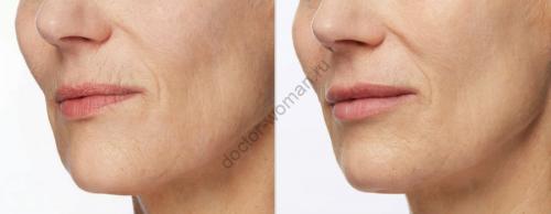 Морщины вокруг губ народные средства. Как уменьшить морщины вокруг рта