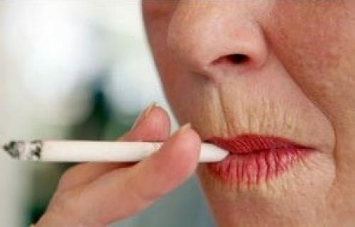 Коррекция кисетных морщин над верхней губой. Эффективный способ убрать морщины над верхней губой 01