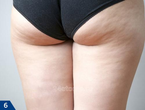 LPG массаж до и после. Оптимальные показания к LPG-массажу  –