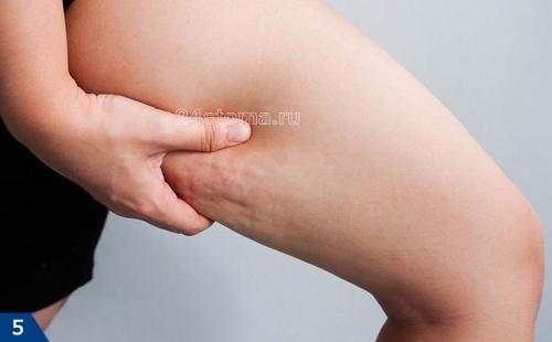 LPG массаж до и после. Оптимальные показания к LPG-массажу  –