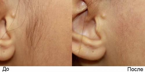 Сколько стоит лазерная эпиляция?