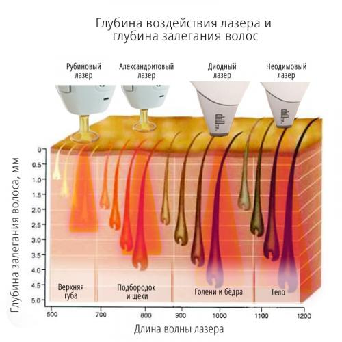 Может ли количество сеансов лазерной эпиляции зависеть от типа кожи. Какие типы лазеров применяют для эпиляции