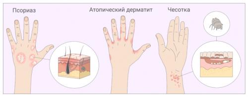 Какие виды кожных заболеваний могут вызывать покалывание и зуд в руках и ногах. Почему чешется кожа?