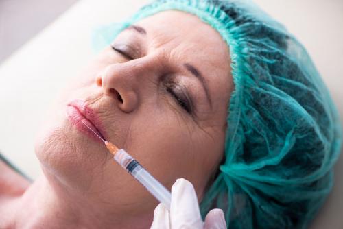 Кисетные морщины вокруг рта. Причины появления кисетных морщин 04