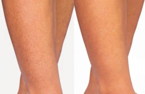 Могут ли волосы вырасти снова после завершения курса лазерной эпиляции. Среднее время ожидания