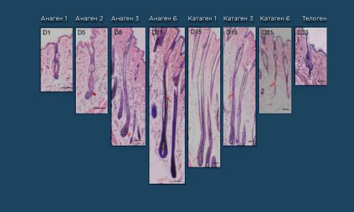 Что влияет на эффективность лазерной эпиляции и количество процедур. Анаген