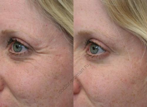 После ботокса кожа быстрее стареет. Молодость сохранить можно, но есть опасения —, что нас ждет после инъекции ботулотоксина?