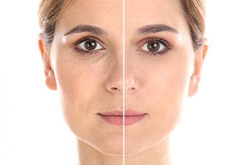 Отеки под глазами после ботокса. В каких случаях ботокс для зоны вокруг глаз эффективен? 01