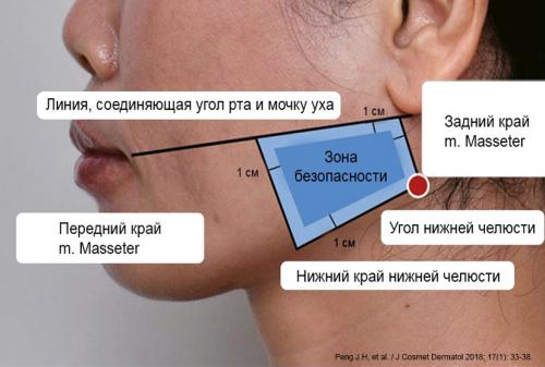 Осложнения ботулинотерапии при гипертрофии жевательных мышц. Ботокс в жевательные мышцы 02