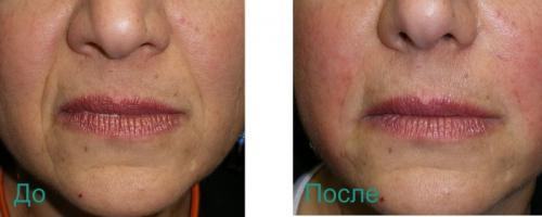Как убрать носогубные складки косметология. Удаление носогубных складок на лице